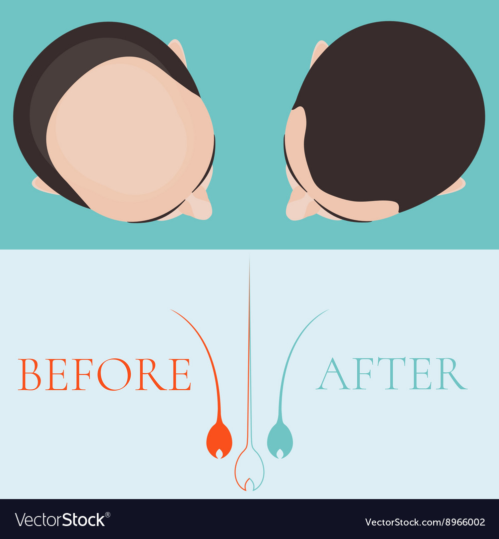 Bald Man Before And After Hair Treatment Vector Image
