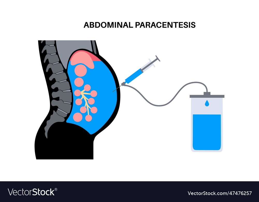 Abdominal paracentesis poster Royalty Free Vector Image