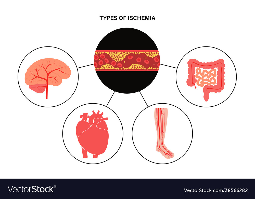 Types ishemia