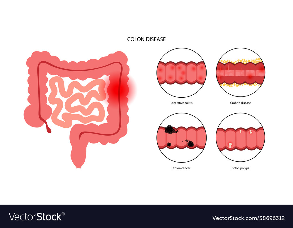 Intestines diseases concept