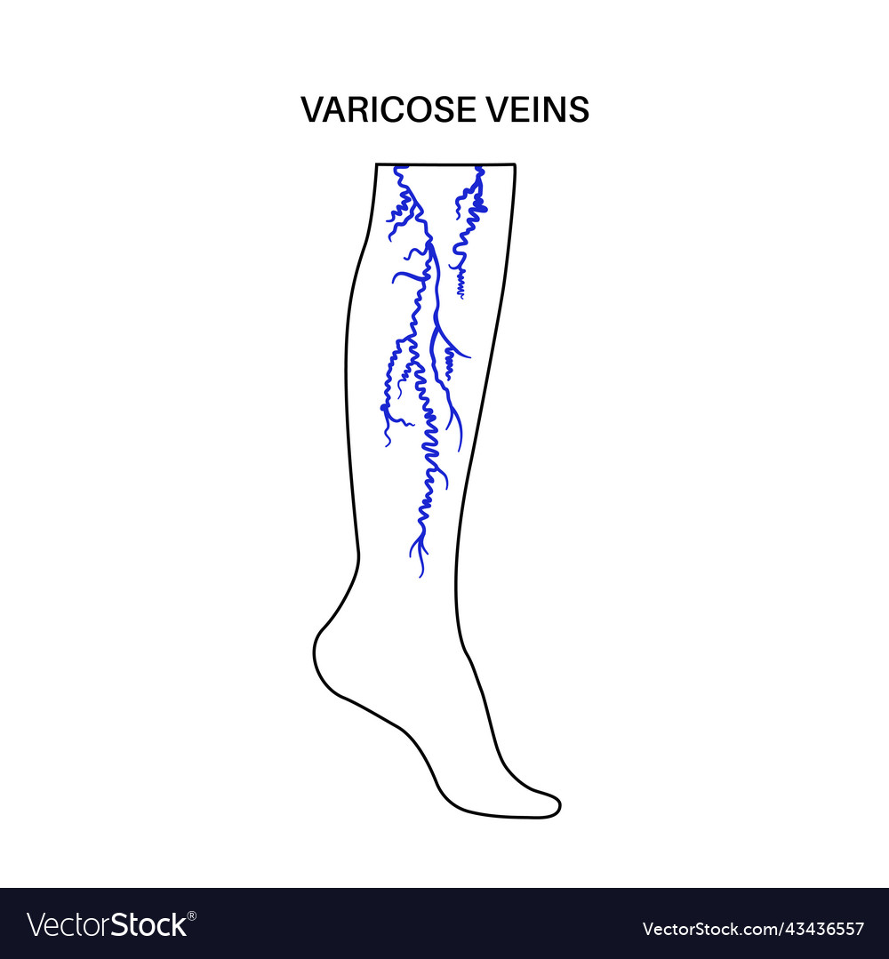 Varicose veins treatment