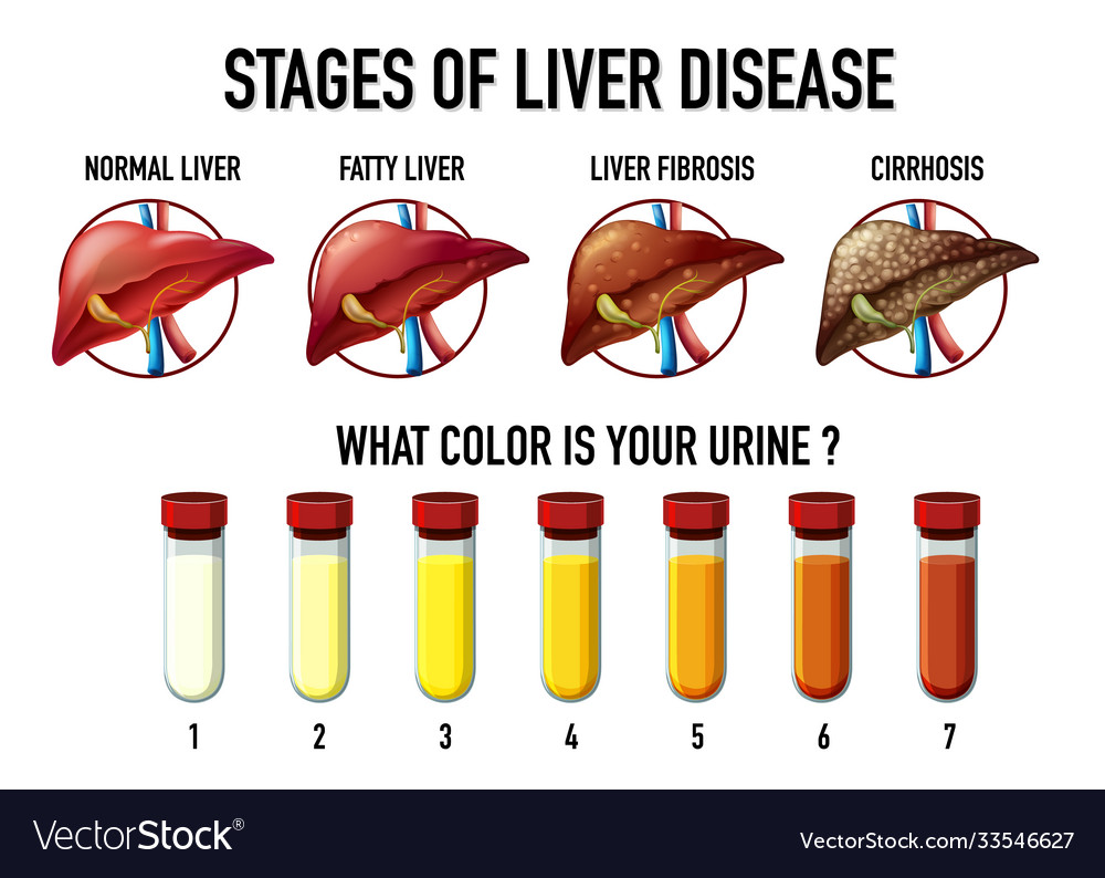 Stages liver disease Royalty Free Vector Image