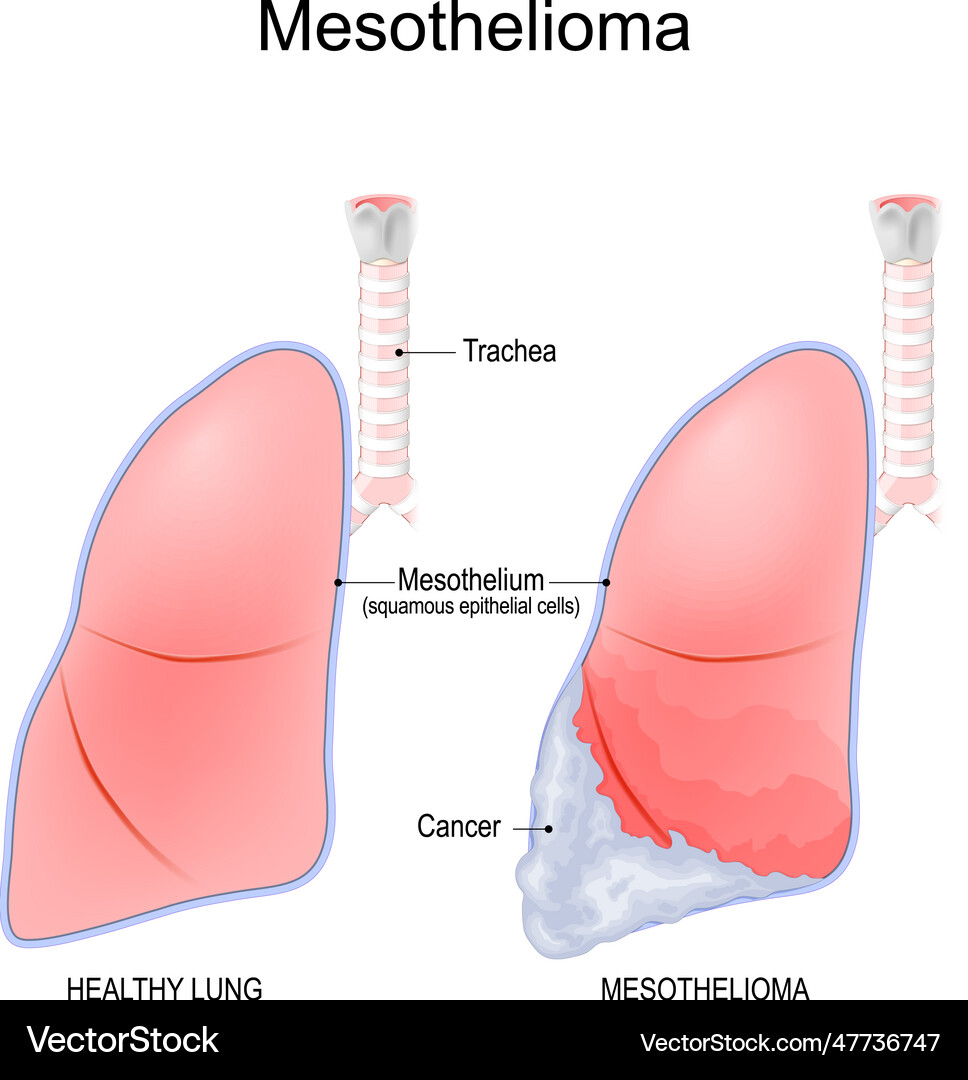 Breathtaking What Cancers Are Related To Mesothelioma Landscape for Mobile Breathtaking What Cancers Are Related To Mesothelioma Landscape for Mobile