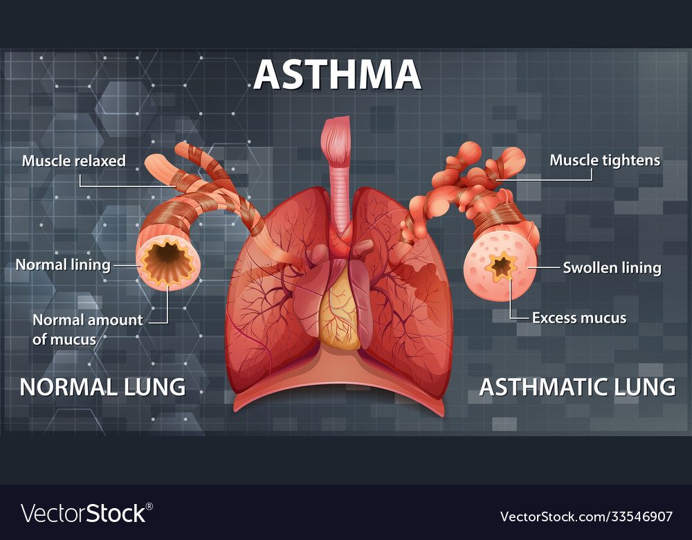 Comparison healthy lung and asthmatic lung Vector Image