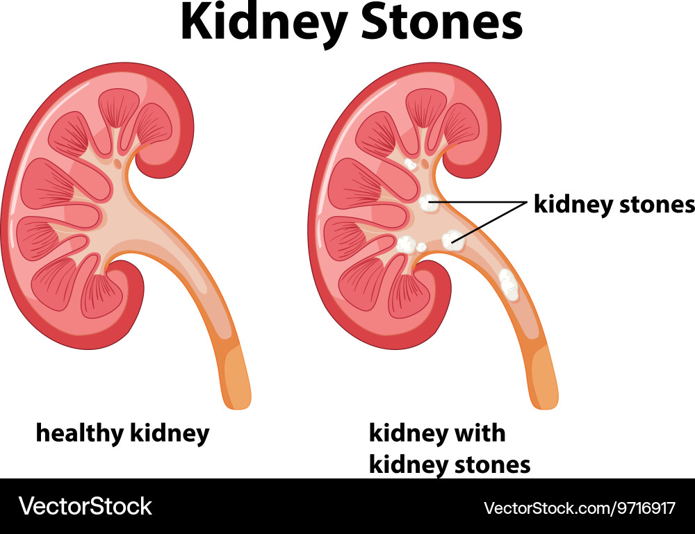 Diagram kidney stones Royalty Free Vector Image
