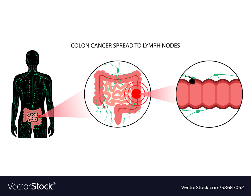 Colon cancer stage