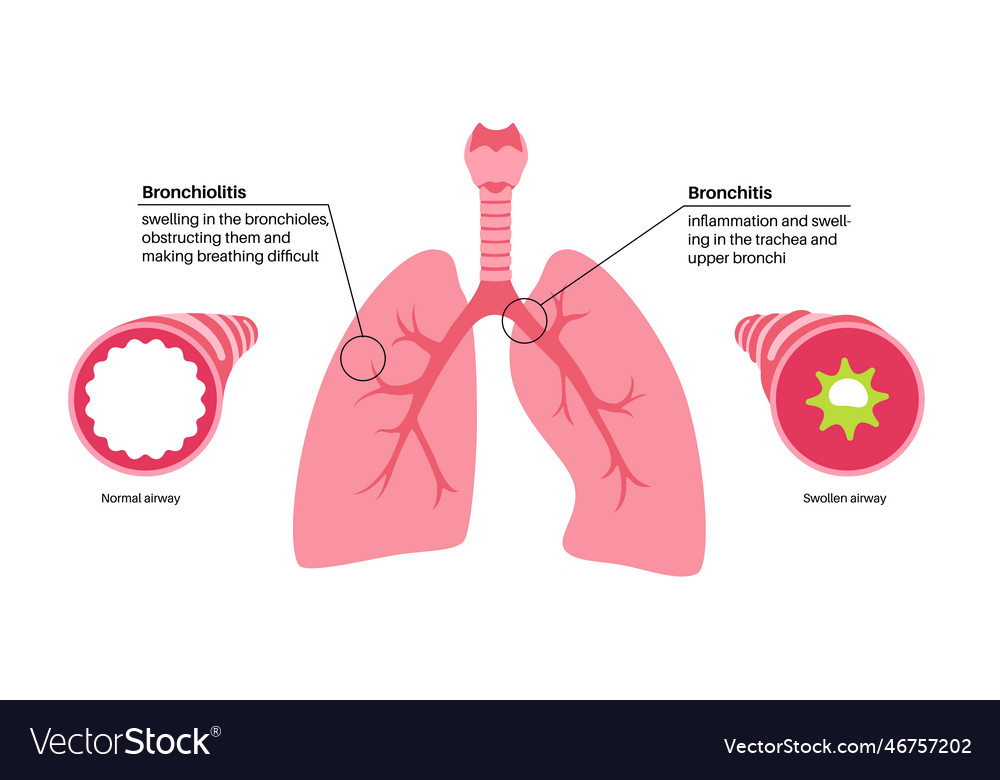 Bronchitis and bronchiolitis Royalty Free Vector Image