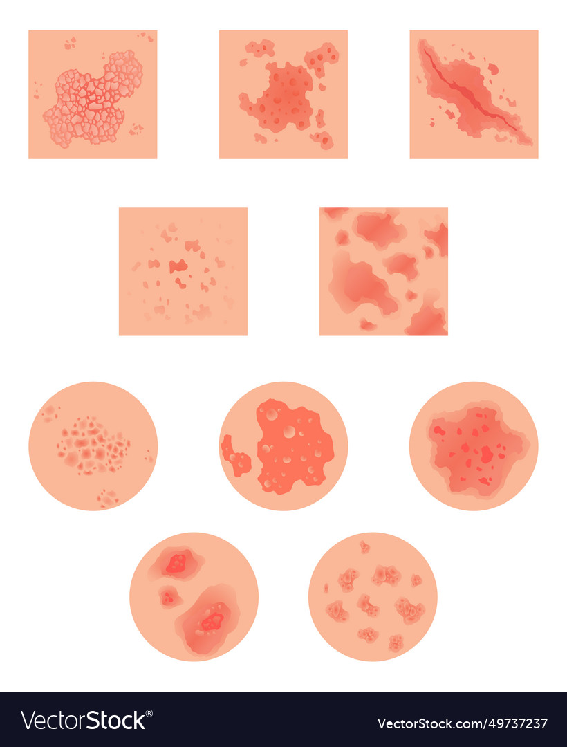 Different types of psoriasis set part vector image Different types of psoriasis set part