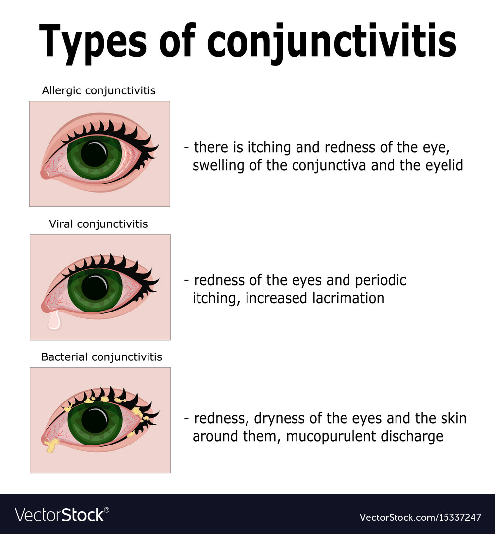 Types of conjunctivitis Royalty Free Vector Image