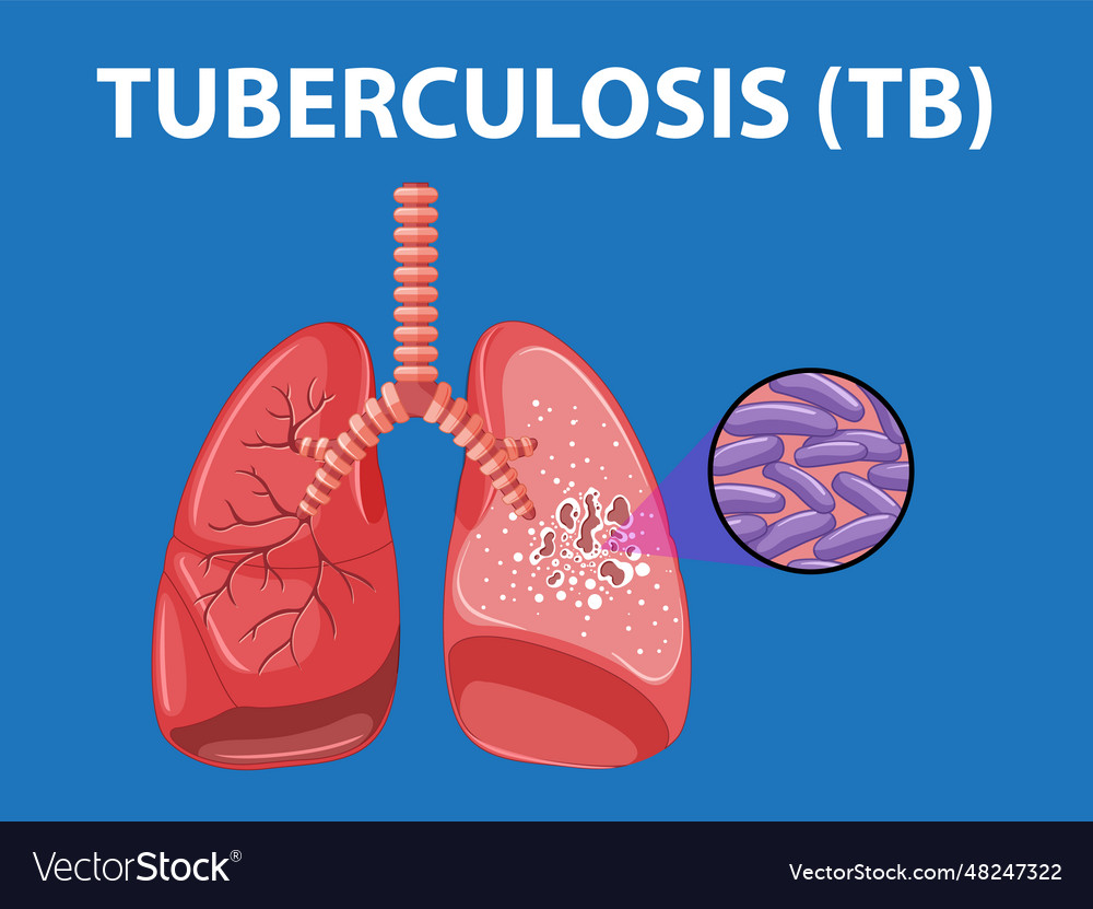 Human lung anatomy with tuberculosis infographic Vector Image