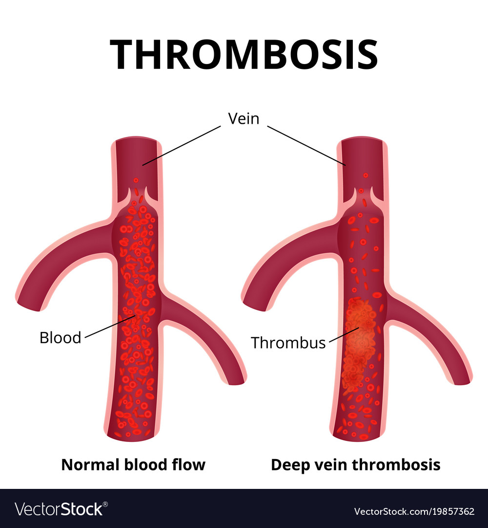 Thrombus formation