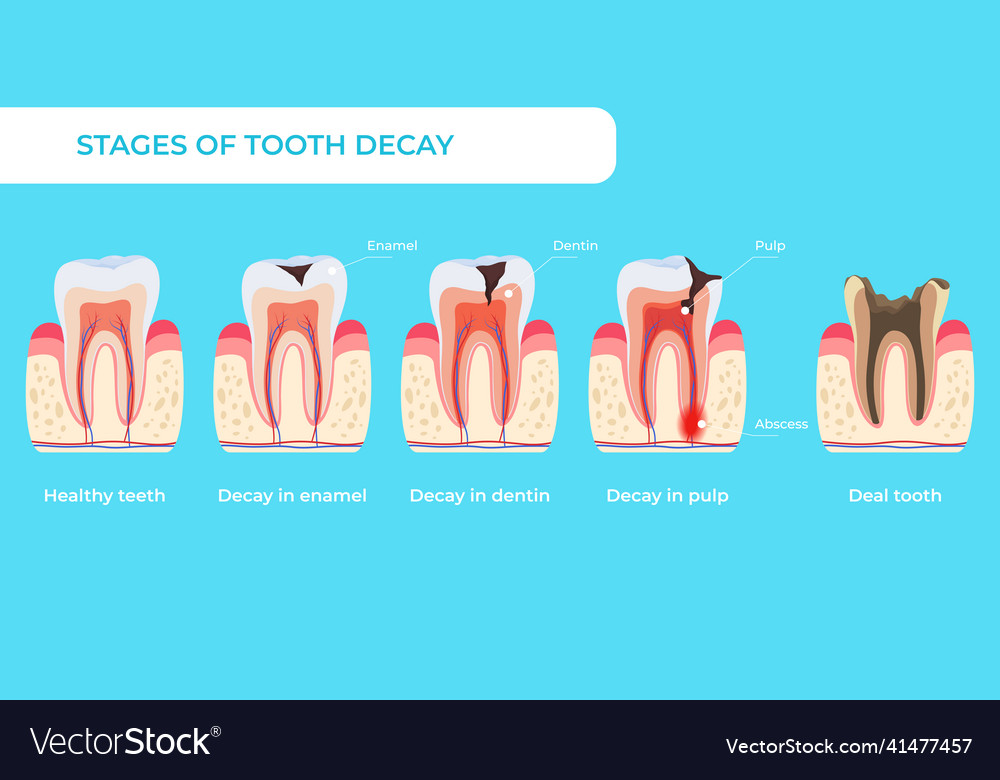 Stage tooth decay infographic medical educational Vector Image