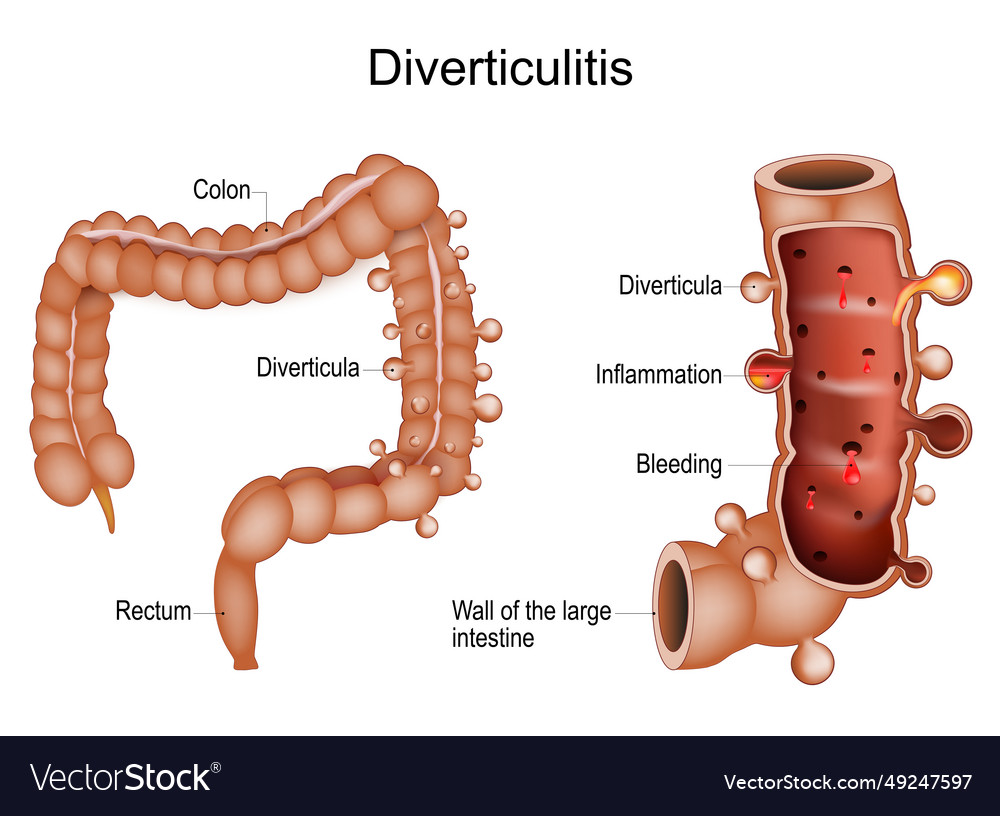 what is the meaning of colonic diverticulosis