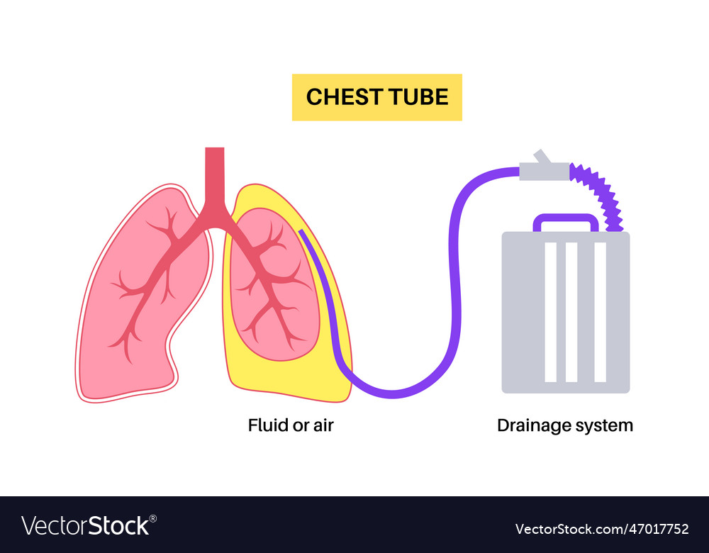 Chest tube catheter Royalty Free Vector Image - VectorStock