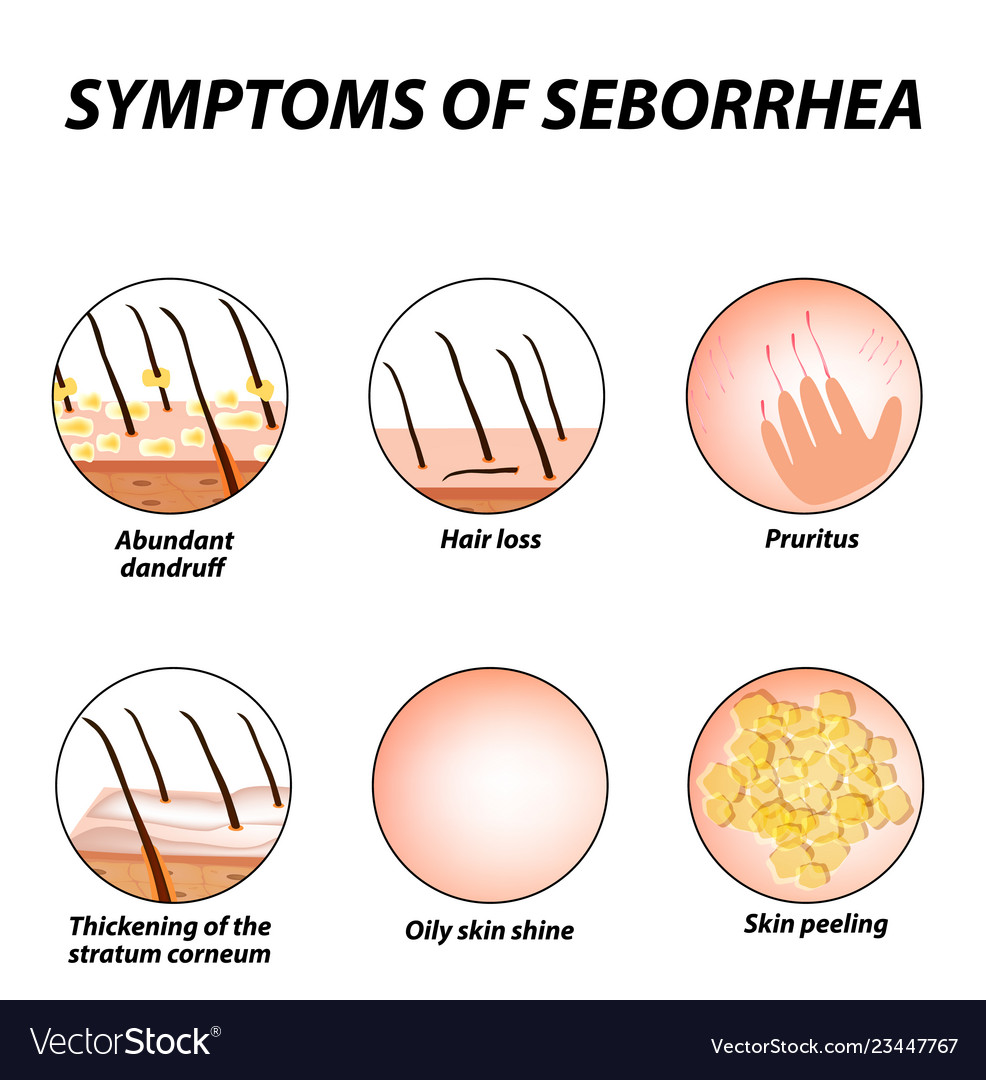 Symptoms of seborrhea skin and hair