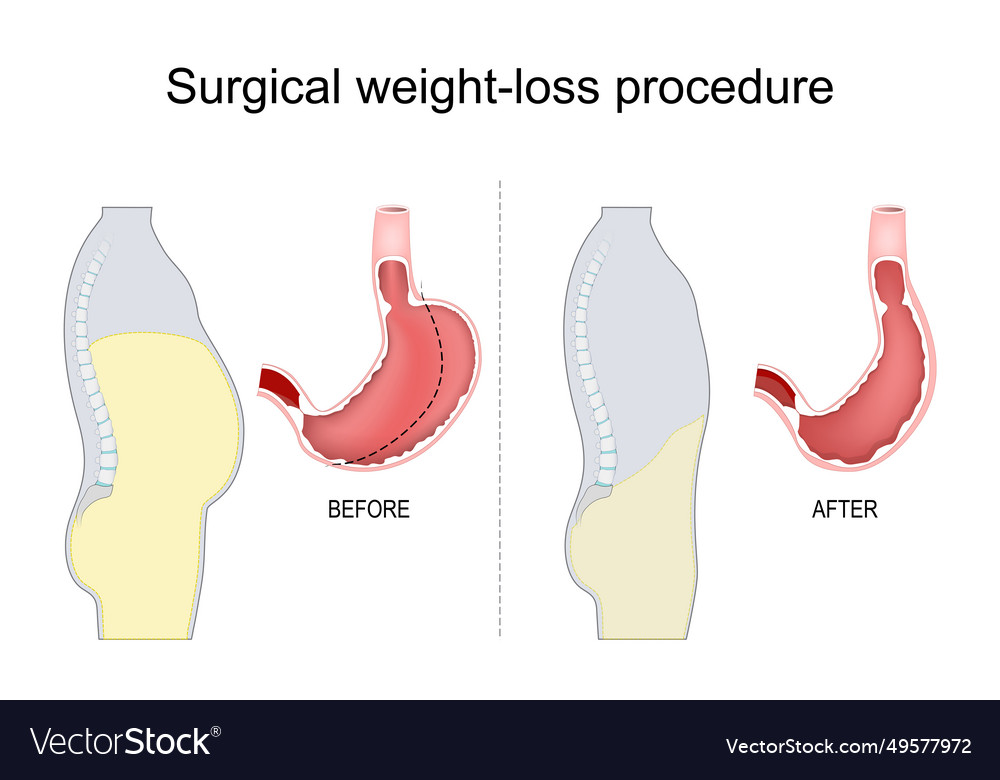 Stomach reduction vertical sleeve gastrectomy