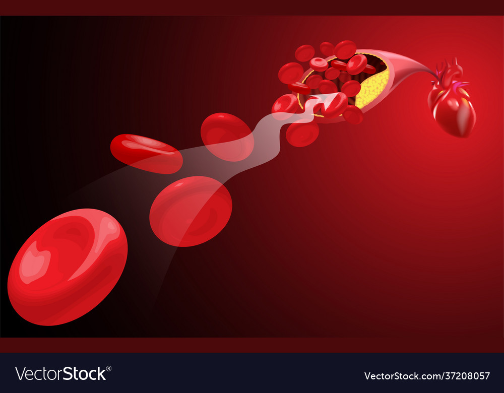 Flow red blood cells is blocked atheroma Vector Image