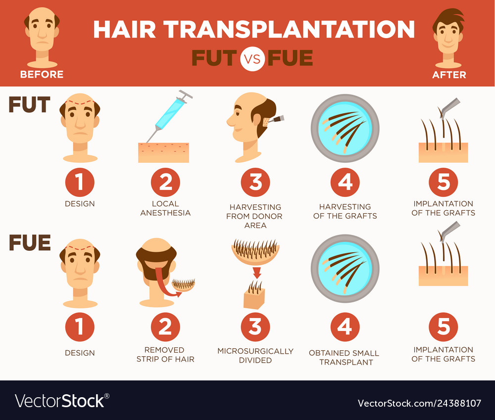 Hair transplantation surgery cosmetic procedure Vector Image