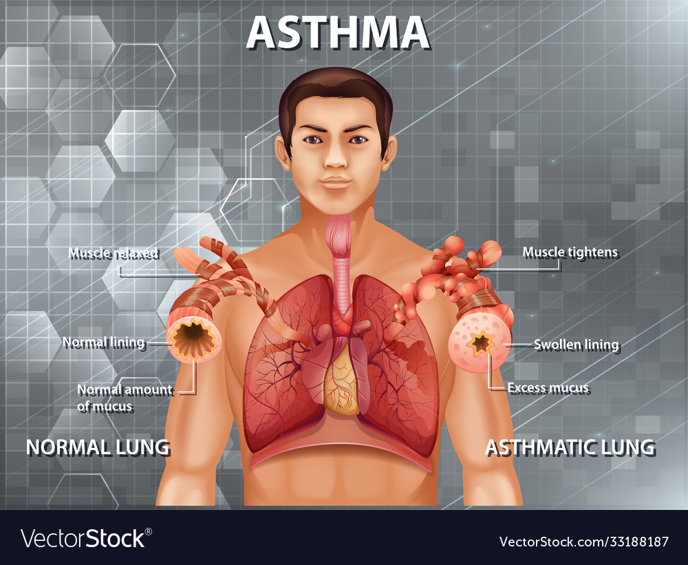 Comparison healthy lung and asthmatic Royalty Free Vector