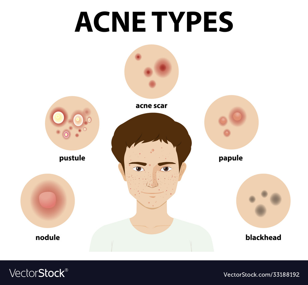 Types acne on skin or pimples Royalty Free Vector Image