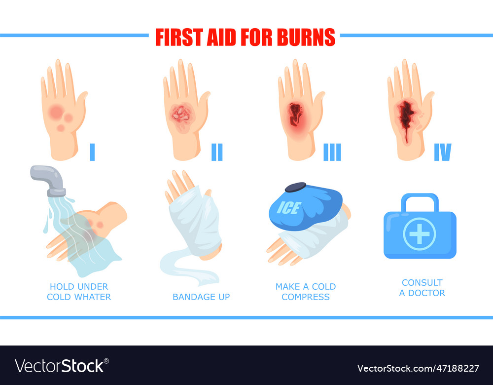 Ways of healing different skin burn injuries Vector Image