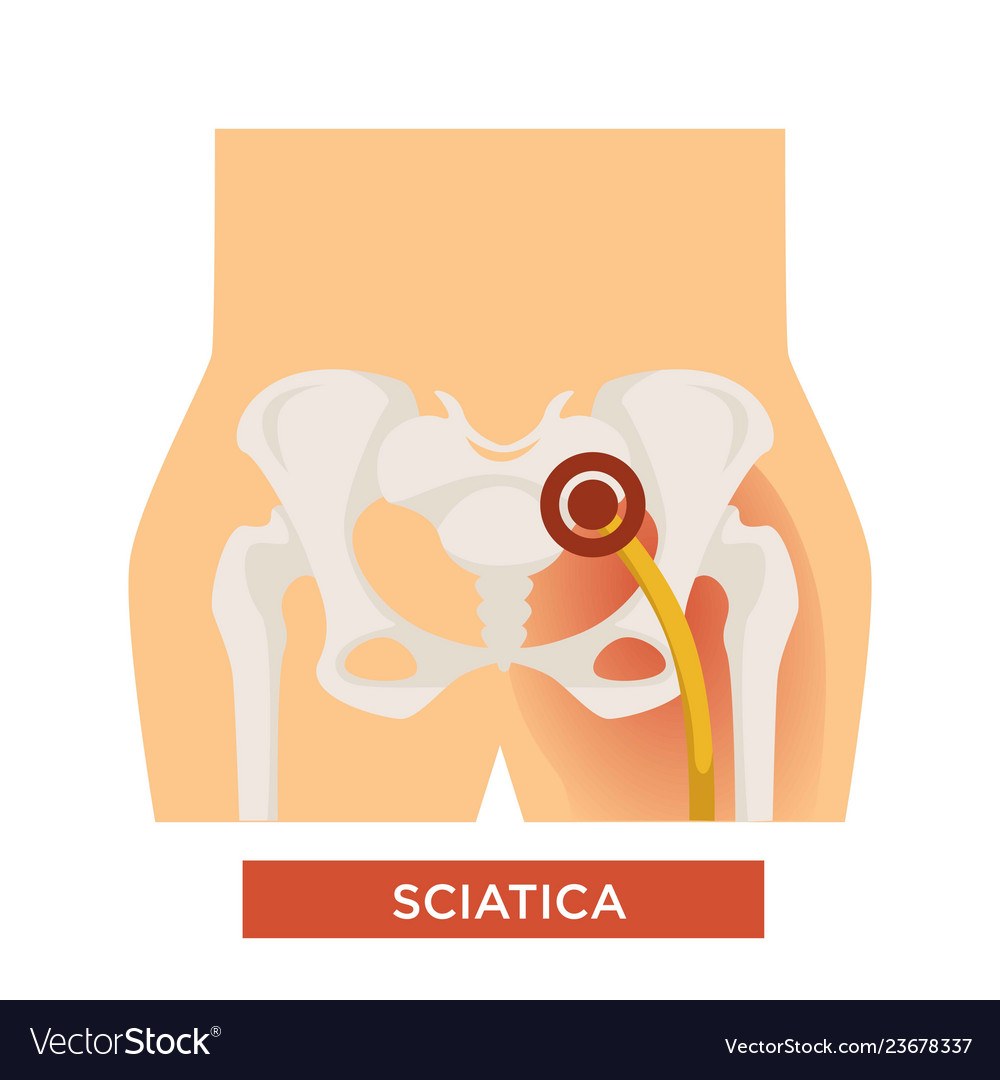 Sciatica bone disease sciatic back pain hip bone Vector Image