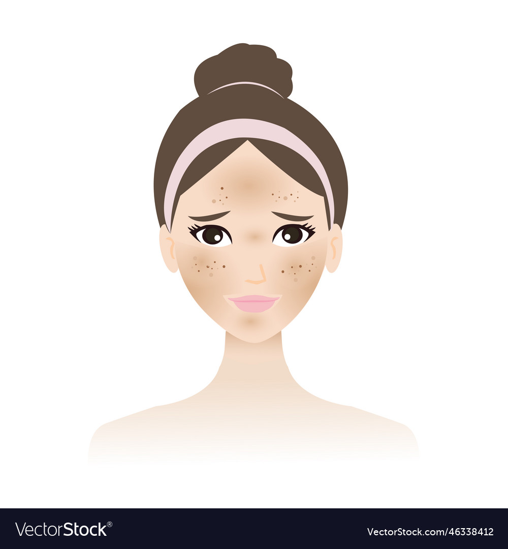 Hyperpigmentation and melasma vector image Hyperpigmentation and melasma