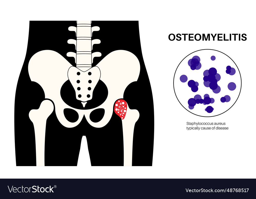 Osteomyelitis of hip Royalty Free Vector Image