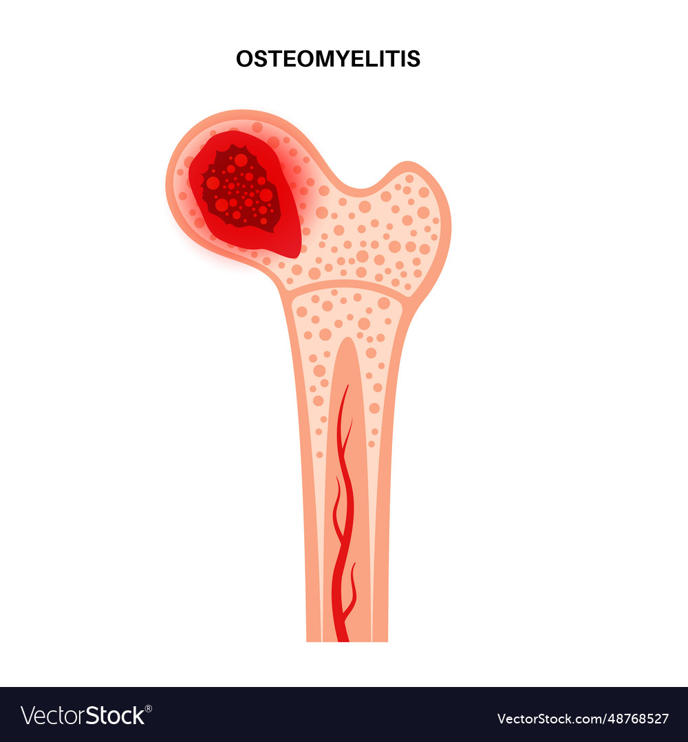 Osteomyelitis of hip Royalty Free Vector Image