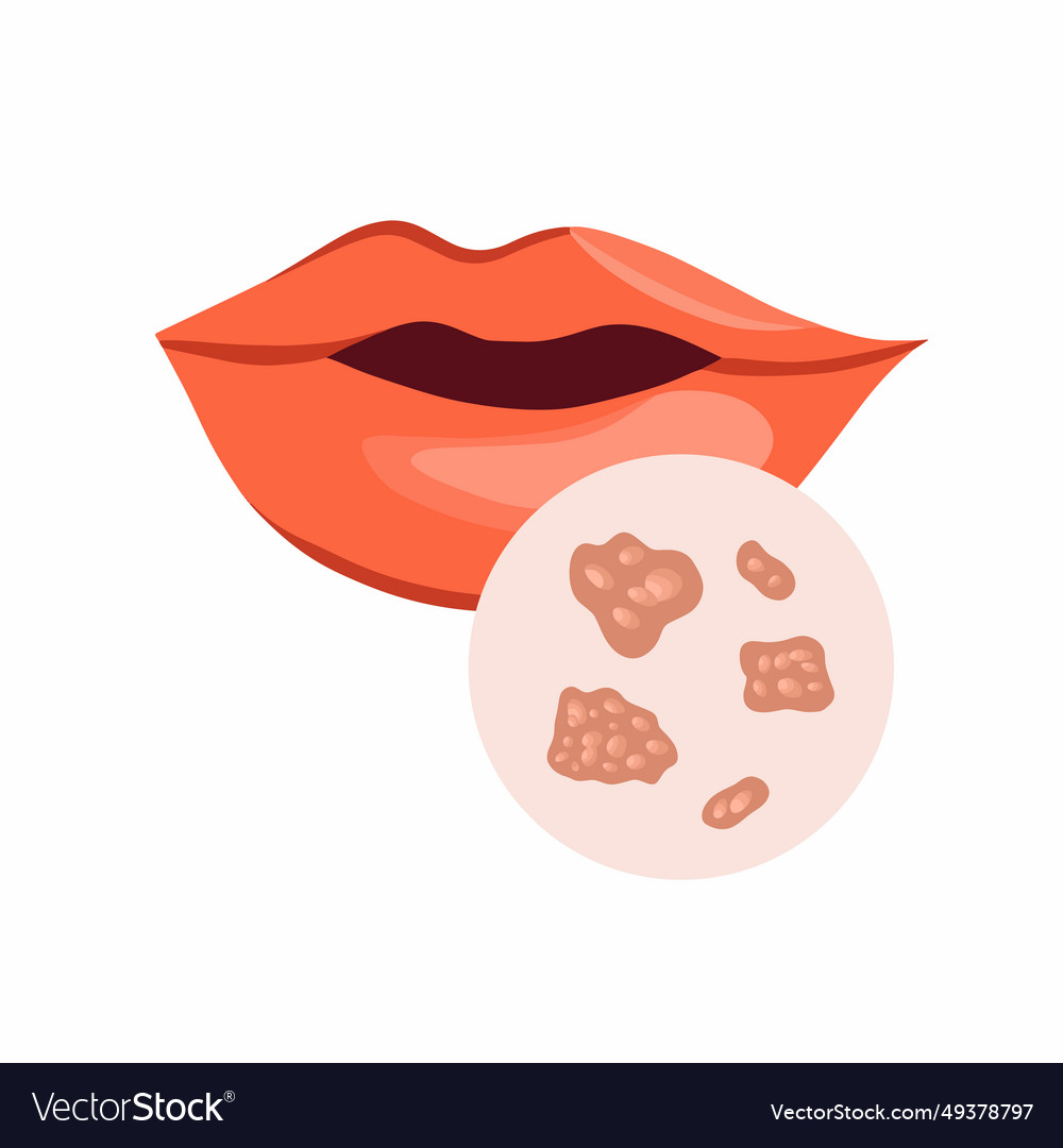 herpes-on-the-lips-royalty-free-vector-image-vectorstock