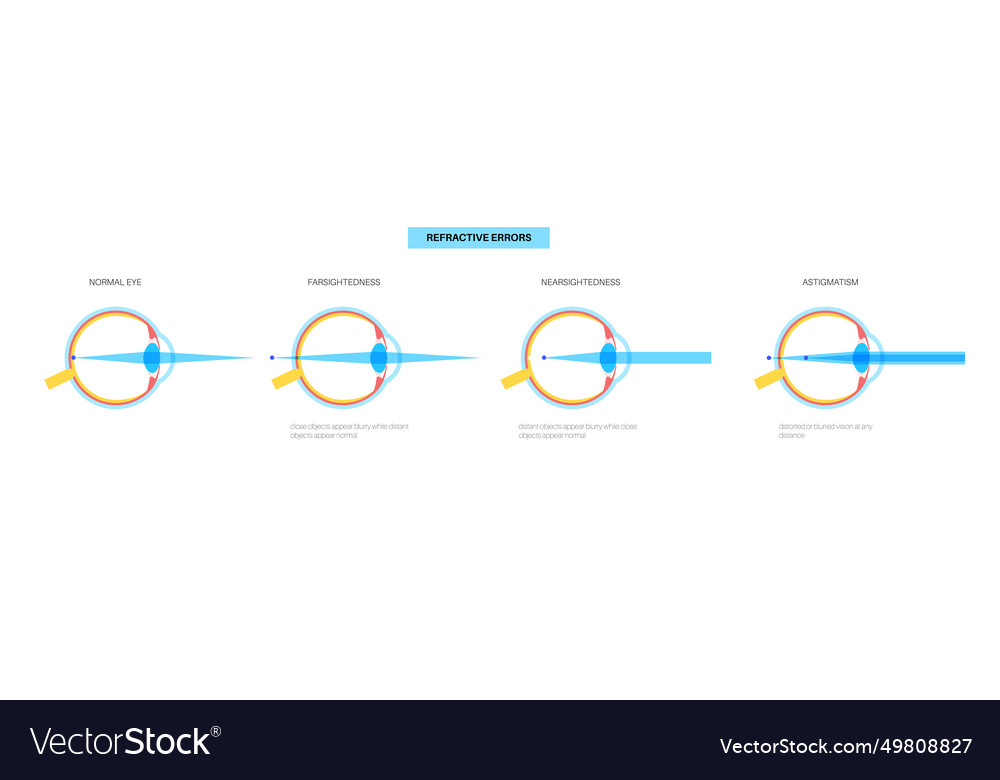 Refractive errors poster vector image Refractive errors poster