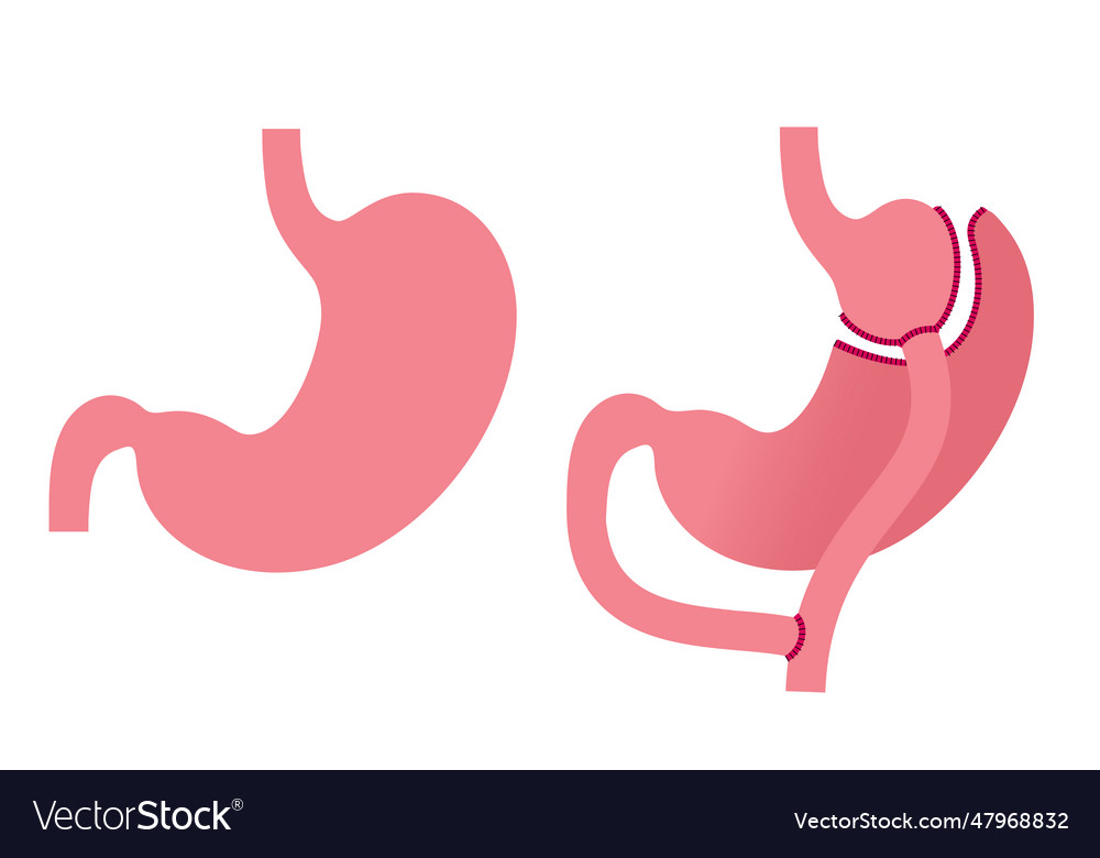 Gastric Bypass Surgery Royalty Free Vector Image