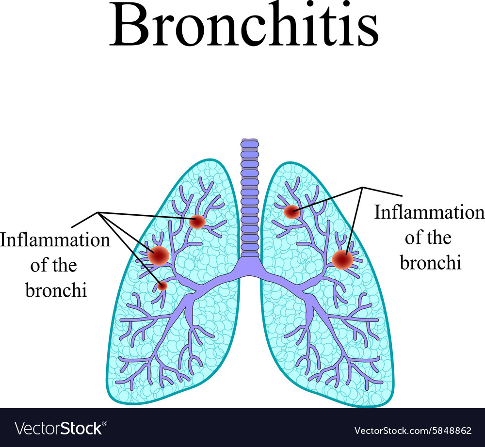 Bronchitis the anatomical structure of human Vector Image