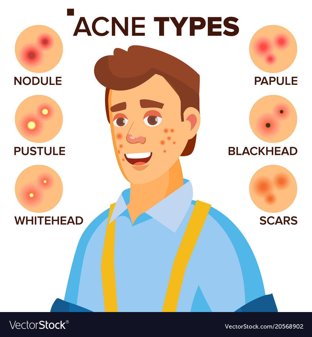 Acne types man with facial skin Royalty Free Vector Image