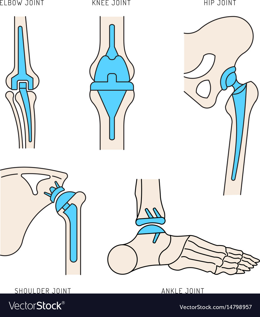 Implantation joint skeleton