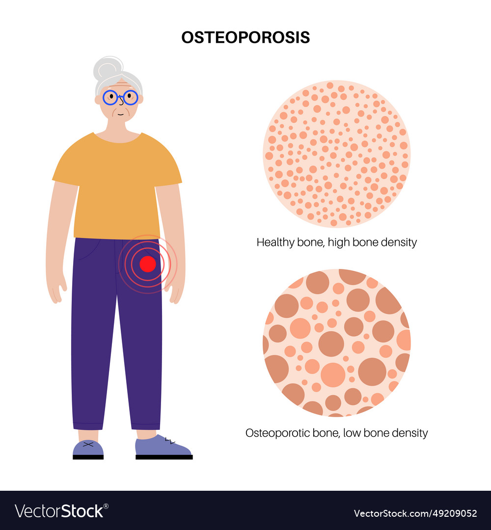 Osteoporosis medical poster