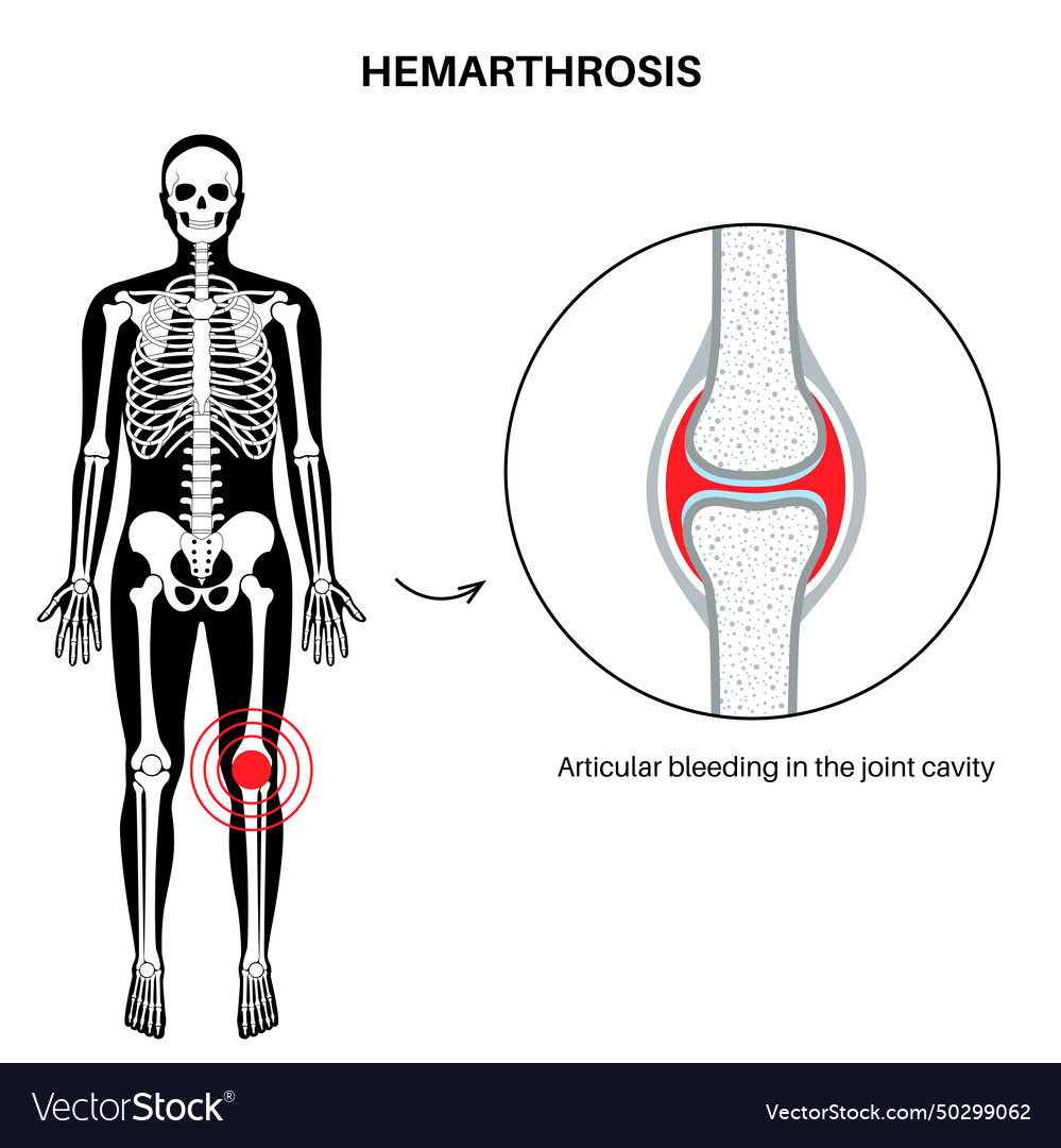 Hemarthrosis in the synovial joint