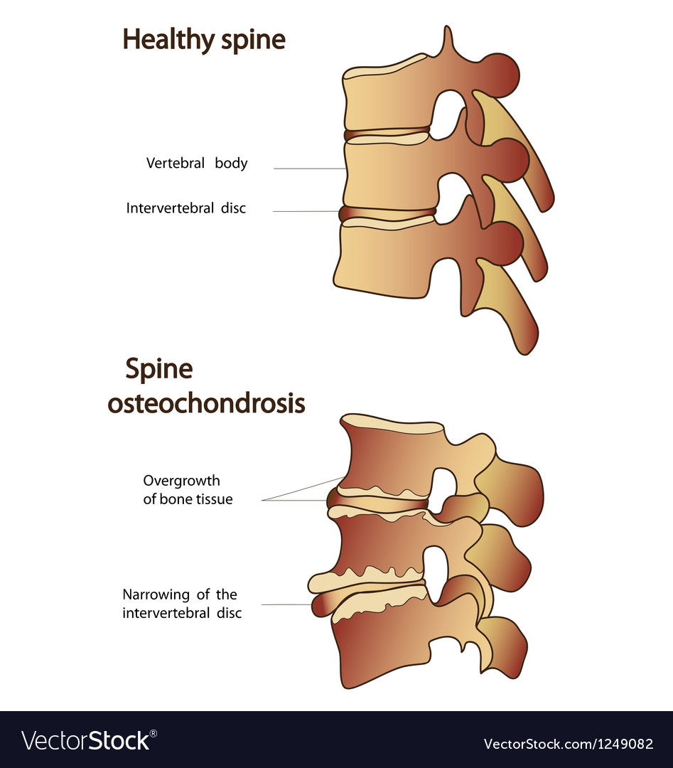 spinal osteochondrosis)