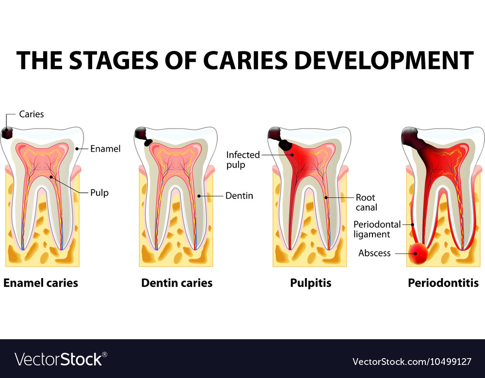 Dental disease caries pulpitis and periodontitis Vector Image