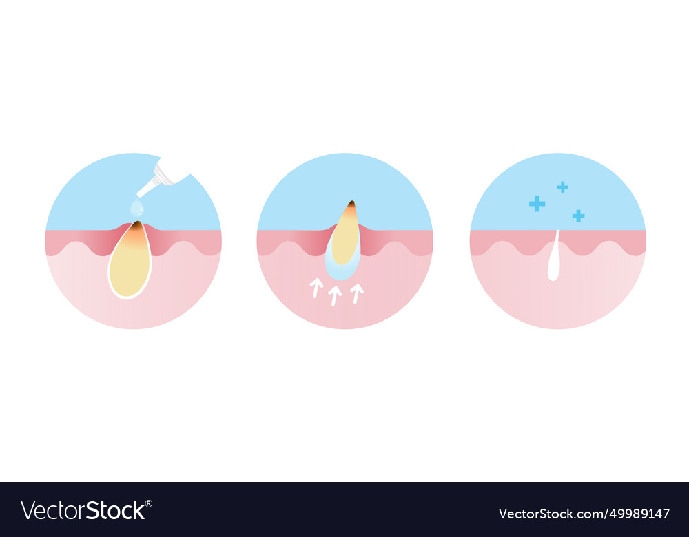 Blackhead treatment gel icon set