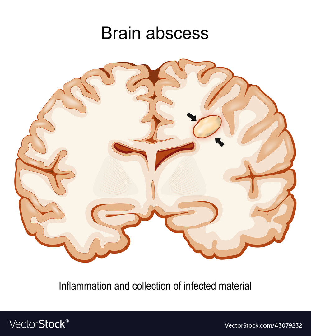 Brain abscess cerebral cross section