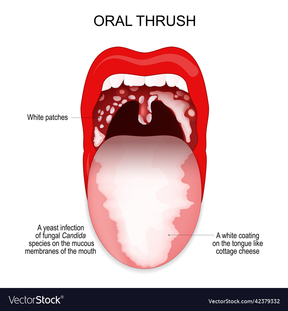 Oral thrush a white coating on the tongue Vector Image