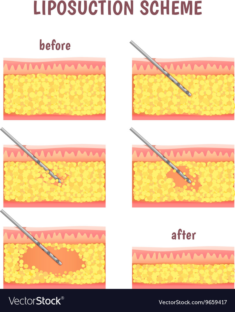 Scheme of cosmetic surgery