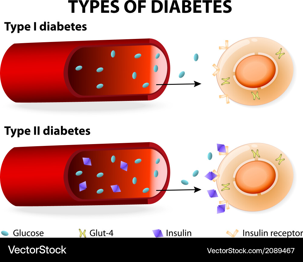 Types diabetes Royalty Free Vector Image - VectorStock