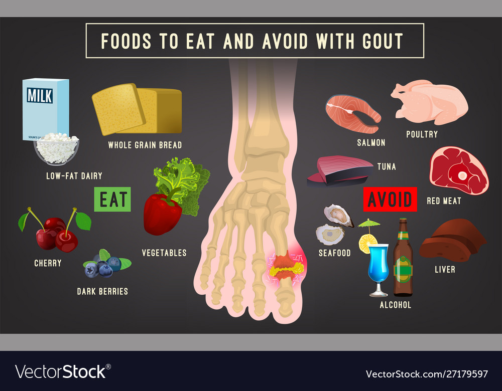 Gout Arthritis Infographic Royalty Free Vector Image