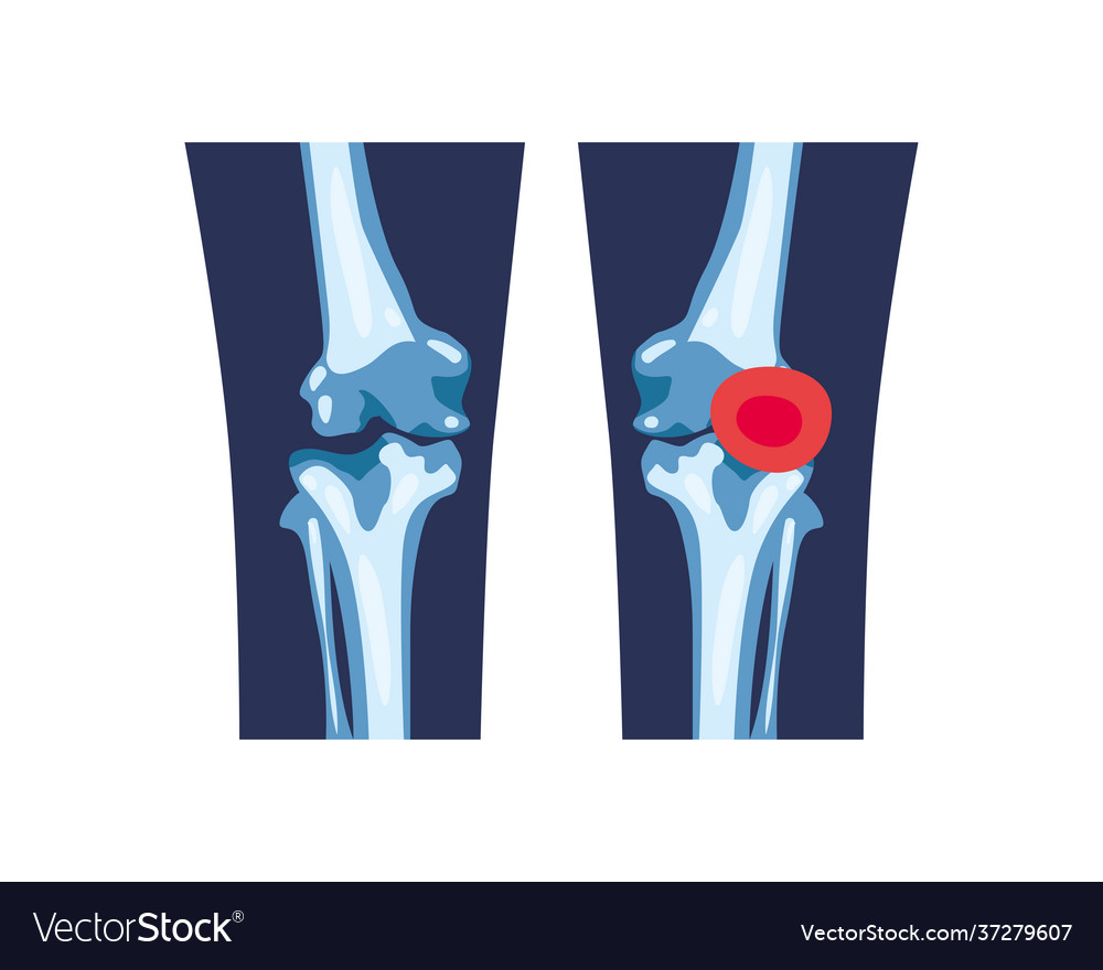 Rheumatology legs bones Royalty Free Vector Image