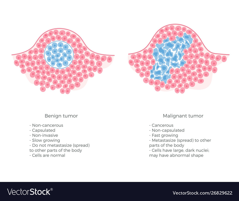 malignant-and-benign-tumor-royalty-free-vector-image