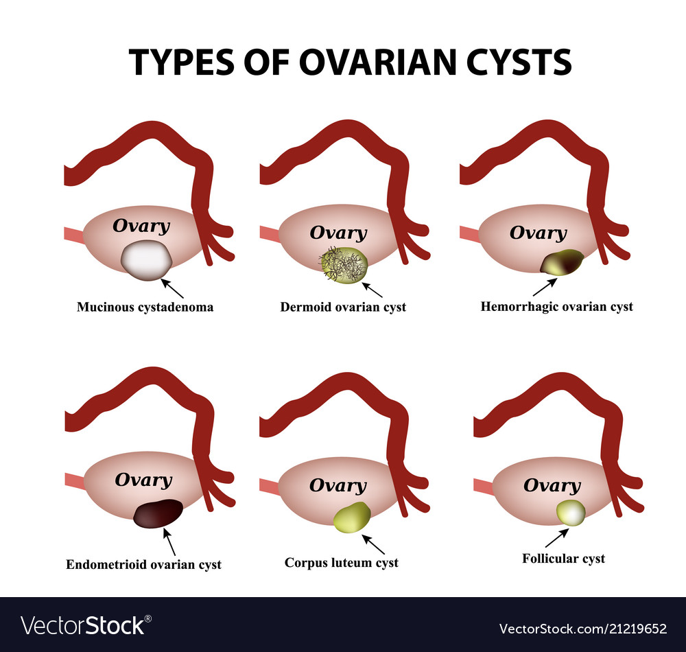 Types of ovarian cysts set infographics Royalty Free Vector