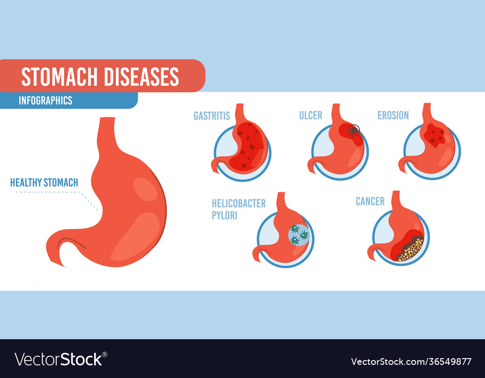 Flat cartoon infographic stomach diseases Vector Image