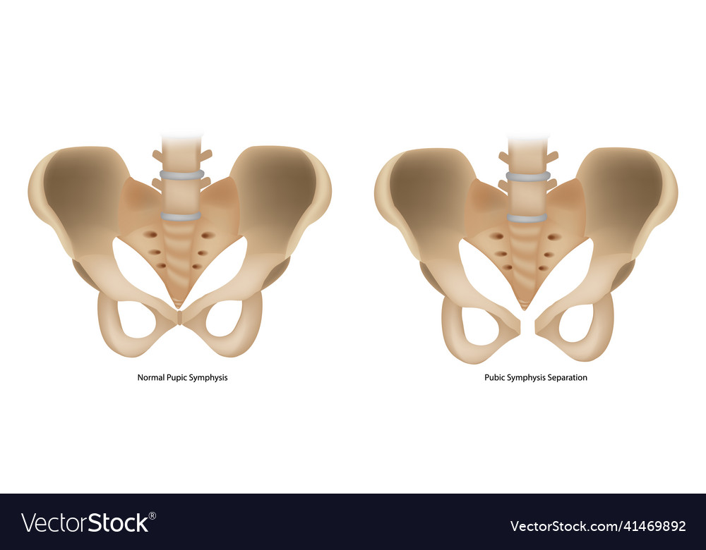 pubic-symphysis-separation-or-spd-symphysis-pubis-vector-image